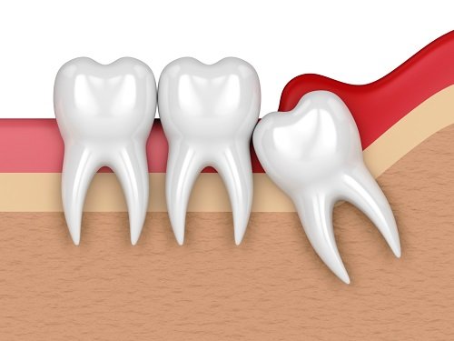 Điều trị viêm lợi trùm răng khôn hiệu quả tại nhà 2