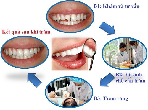 Trám răng sâu - Những điều bạn cần biết 3