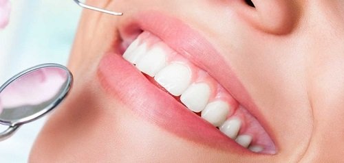 Gel tẩy trắng răng nào nên tin dùng nhất? 3