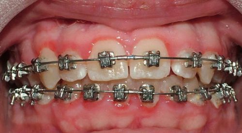 Niềng răng bị viêm lợi - Cách xử lý hiệu quả an toàn 2