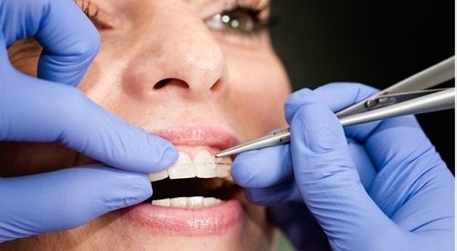 Niềng răng bị viêm lợi - Cách xử lý hiệu quả an toàn 3