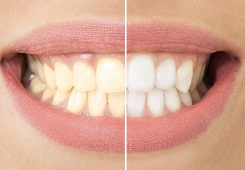 Top 3 thông tin - Tẩy trắng răng có ảnh hưởng gì không? 1