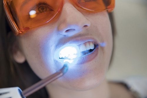 Top 3 thông tin - Tẩy trắng răng có ảnh hưởng gì không? 1
