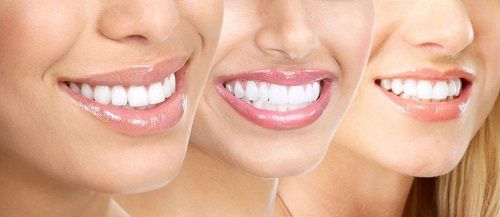 Top 3 thông tin - Tẩy trắng răng có ảnh hưởng gì không? 3