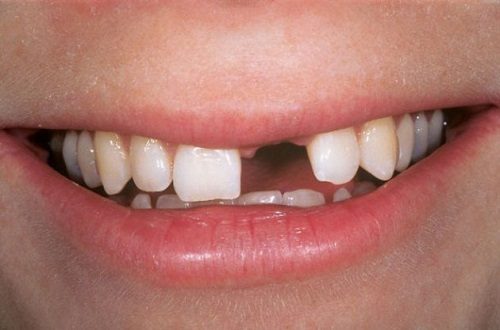 Trồng răng cửa mất bao lâu? Phụ thuộc yếu tố nào? 1