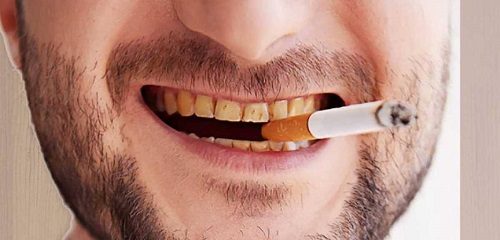 Tẩy trắng răng hút thuốc có sao không? Lời khuyên từ nha khoa 1