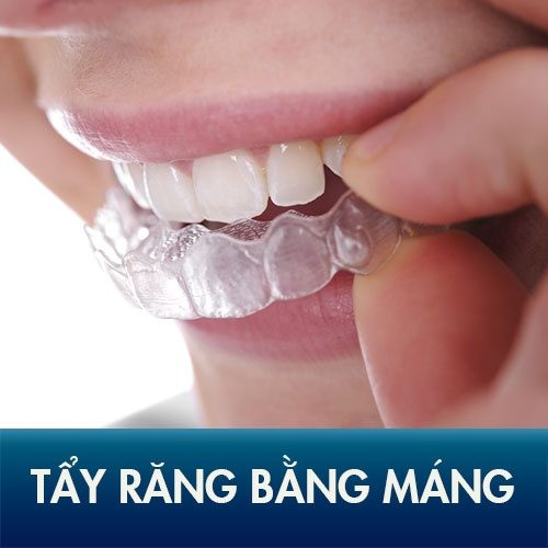 Tẩy trắng răng bằng máng bao nhiêu tiền? Tham khảo 1